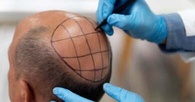 Affordable Hair Transplant Cost: What You Need to Know